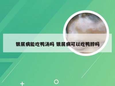 银屑病能吃鸭汤吗 银屑病可以吃鸭脖吗