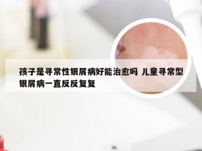 孩子是寻常性银屑病好能治愈吗 儿童寻常型银屑病一直反反复复