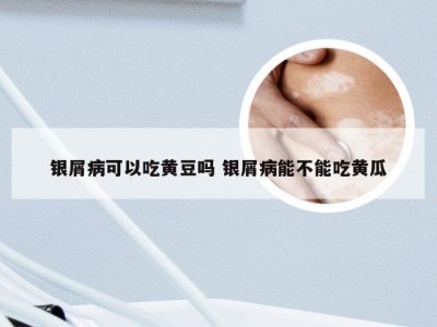 银屑病可以吃黄豆吗 银屑病能不能吃黄瓜