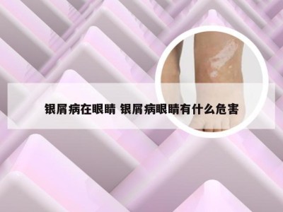 银屑病在眼睛 银屑病眼睛有什么危害