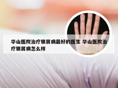 华山医院治疗银屑病最好的医生 华山医院治疗银屑病怎么样