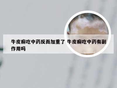 牛皮癣吃中药反而加重了 牛皮癣吃中药有副作用吗
