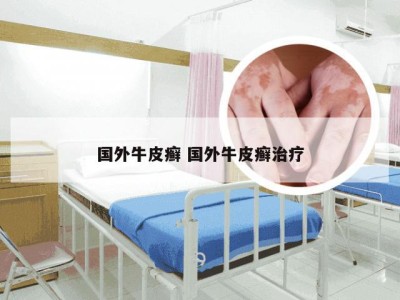 国外牛皮癣 国外牛皮癣治疗