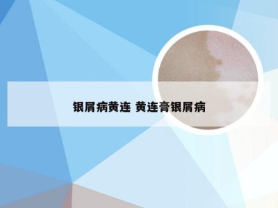 银屑病黄连 黄连膏银屑病