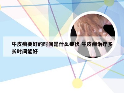 牛皮癣要好的时间是什么症状 牛皮癣治疗多长时间能好