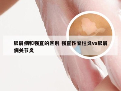 银屑病和强直的区别 强直性脊柱炎vs银屑病关节炎