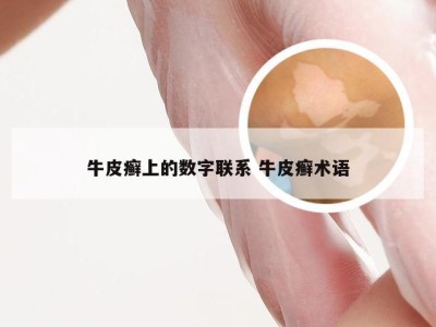 牛皮癣上的数字联系 牛皮癣术语