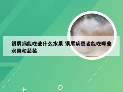 银屑病能吃些什么水果 银屑病患者能吃哪些水果和蔬菜