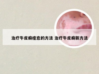治疗牛皮癣痊愈的方法 治疗牛皮癣新方法