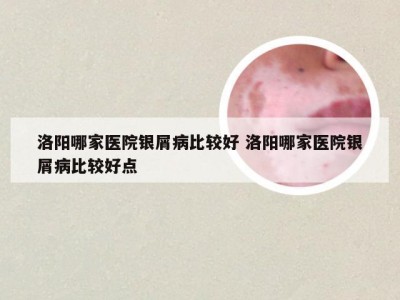 洛阳哪家医院银屑病比较好 洛阳哪家医院银屑病比较好点