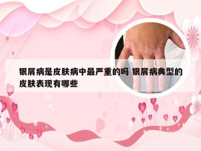 银屑病是皮肤病中最严重的吗 银屑病典型的皮肤表现有哪些