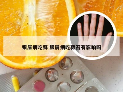 银屑病吃蒜 银屑病吃蒜苔有影响吗