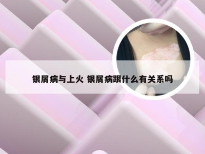 银屑病与上火 银屑病跟什么有关系吗