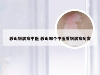 鞍山银屑病中医 鞍山哪个中医看银屑病厉害