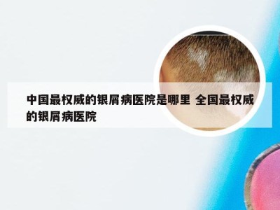 中国最权威的银屑病医院是哪里 全国最权威的银屑病医院