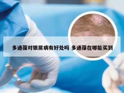 多通葆对银屑病有好处吗 多通葆在哪能买到