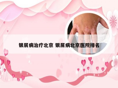 银屑病治疗北京 银屑病北京医院排名