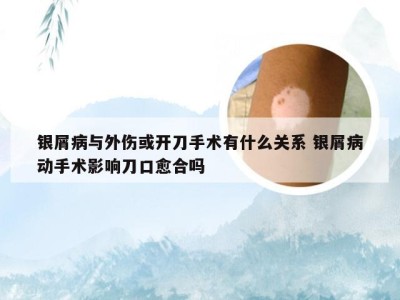 银屑病与外伤或开刀手术有什么关系 银屑病动手术影响刀口愈合吗
