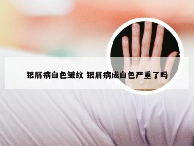 银屑病白色皱纹 银屑病成白色严重了吗
