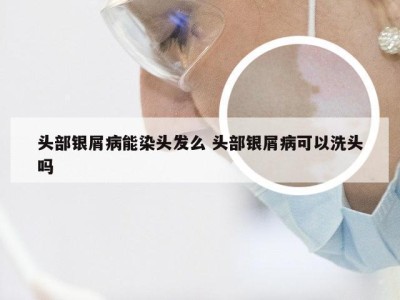 头部银屑病能染头发么 头部银屑病可以洗头吗