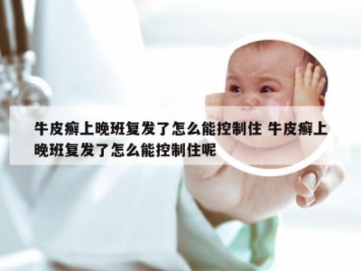 牛皮癣上晚班复发了怎么能控制住 牛皮癣上晚班复发了怎么能控制住呢