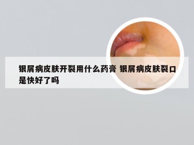 银屑病皮肤开裂用什么药膏 银屑病皮肤裂口是快好了吗