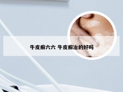牛皮癣六六 牛皮癣冶的好吗