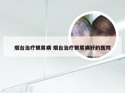烟台治疗银屑病 烟台治疗银屑病好的医院