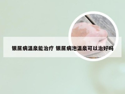 银屑病温泉能治疗 银屑病泡温泉可以治好吗