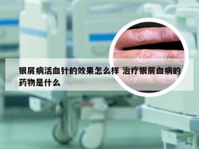 银屑病活血针的效果怎么样 治疗银屑血病的药物是什么