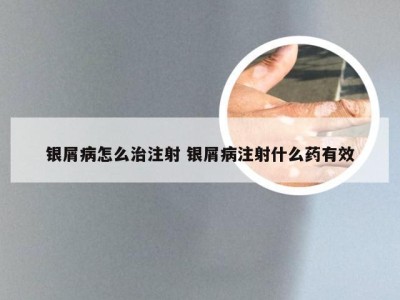银屑病怎么治注射 银屑病注射什么药有效