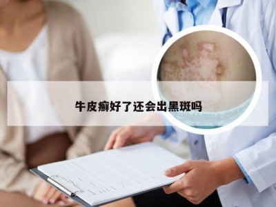 牛皮癣好了还会出黑斑吗