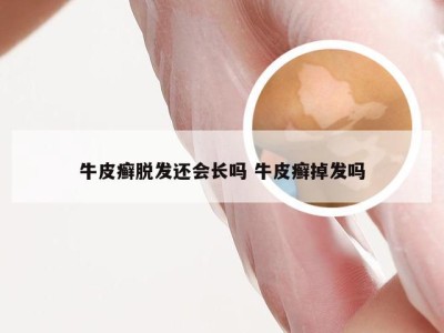 牛皮癣脱发还会长吗 牛皮癣掉发吗
