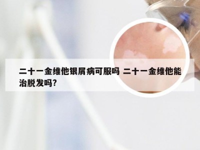 二十一金维他银屑病可服吗 二十一金维他能治脱发吗?