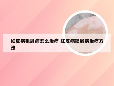 红皮病银屑病怎么治疗 红皮病银屑病治疗方法