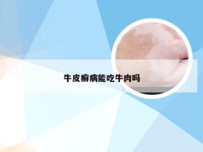 牛皮癣病能吃牛肉吗