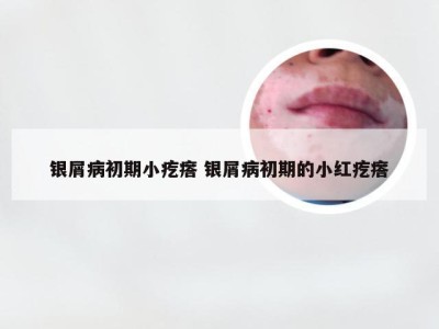 银屑病初期小疙瘩 银屑病初期的小红疙瘩