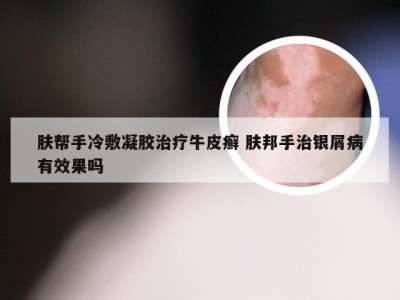 肤帮手冷敷凝胶治疗牛皮癣 肤邦手治银屑病有效果吗