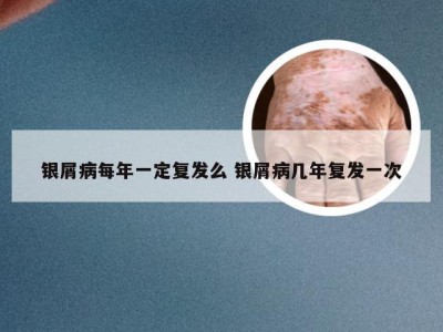 银屑病每年一定复发么 银屑病几年复发一次
