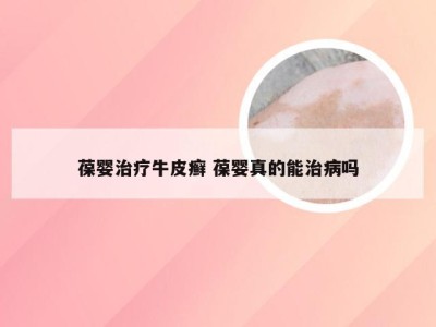葆婴治疗牛皮癣 葆婴真的能治病吗