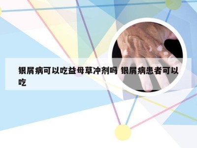 银屑病可以吃益母草冲剂吗 银屑病患者可以吃