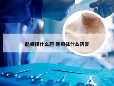 起癣摸什么药 起癣抹什么药膏