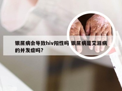 银屑病会导致hiv阳性吗 银屑病是艾滋病的并发症吗?