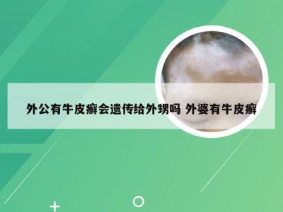 外公有牛皮癣会遗传给外甥吗 外婆有牛皮癣