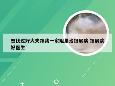 想找过好大夫跟我一家姐弟治银屑病 银屑病好医生