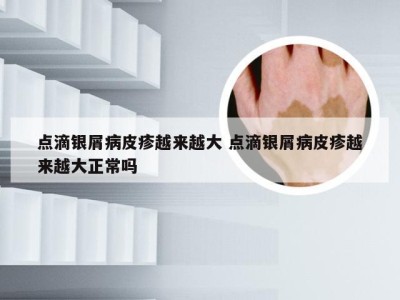 点滴银屑病皮疹越来越大 点滴银屑病皮疹越来越大正常吗