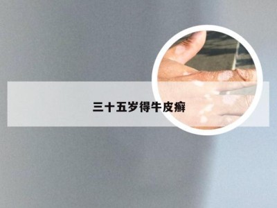 三十五岁得牛皮癣