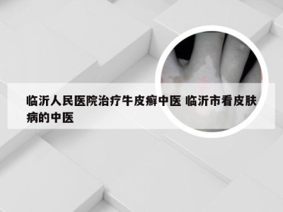 临沂人民医院治疗牛皮癣中医 临沂市看皮肤病的中医