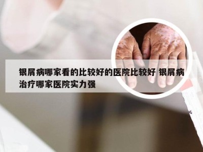 银屑病哪家看的比较好的医院比较好 银屑病治疗哪家医院实力强