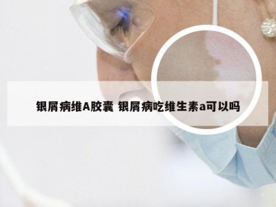 银屑病维A胶囊 银屑病吃维生素a可以吗